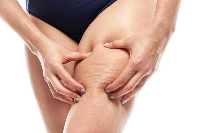 La Farmacia della Natura: la cellulite vi assilla? Ci pensa l’omeopatia