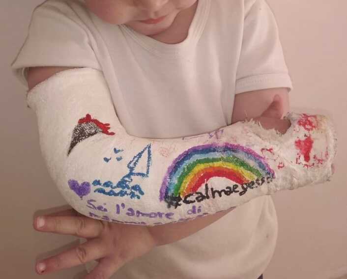 Simboli e messaggi di pace sui gessi dei bimbi del reparto di ortopedia del Giovanni XXIII di Bari