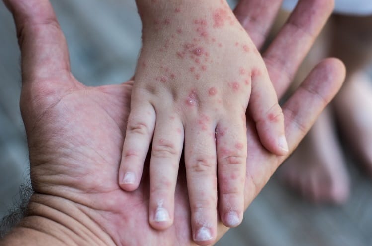 Vaiolo delle scimmie, anche Regione Puglia e Asl alzano il livello di allerta: «Prestare massima attenzione»