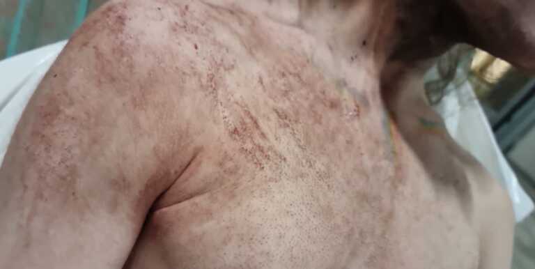 Galleria foto 'Aggressione a Parco Rossani, la vittima: «Volevano uccidermi, ora ho paura»' - foto 1