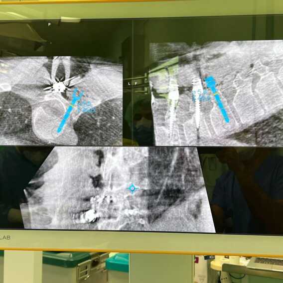 Galleria foto 'Bari, al Policlinico primo intervento su scoliosi computer assistito' - foto 1