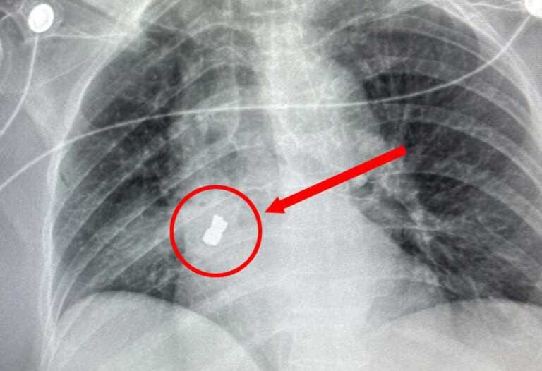 Anziana inala accidentalmente parte della dentiera: operata a San Giovanni Rotondo