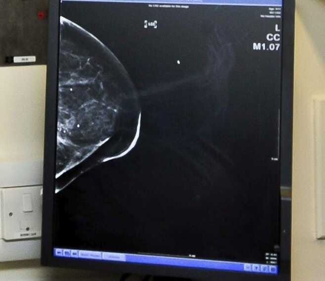 Galleria foto 'Tumore al seno, Fda approva un nuovo farmaco di Menarini' - foto 1