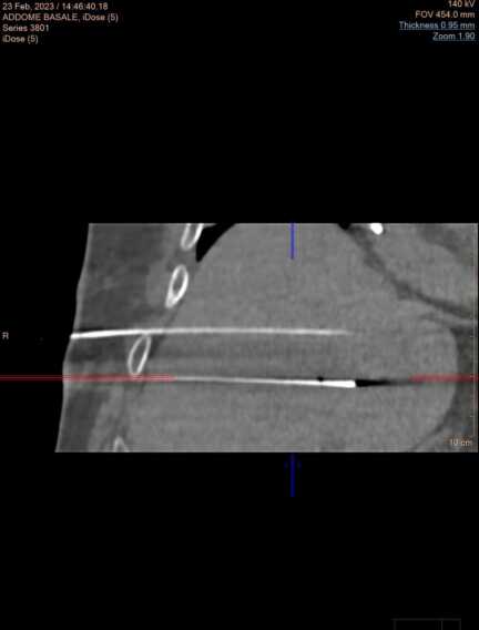 Galleria foto 'Tumore al fegato trattato con un intervento assistito da robot al “De Bellis” di Castellana: è il primo in Italia' - foto 3