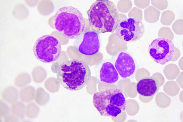 Farmaci contro i tumori grazie allo studio di alterazioni geniche: il “Giovanni Paolo II” nel progetto “Fusion-Target”
