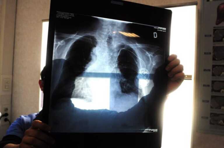Tumore al polmone, in Puglia lo screening comincia in farmacia: 250 quelle che hanno aderito