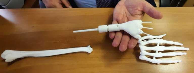 Un polso realizzato con una stampante 3D salva la mano di una neo-mamma
