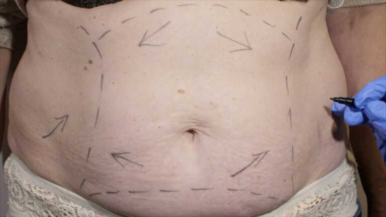 Eccessi cutanei post-dimagrimento, un aiuto dalla chirurgia plastica