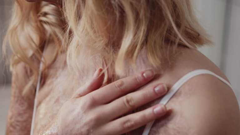 Rimedi alle ustioni, cruciale l’escarectomia selettiva precoce
