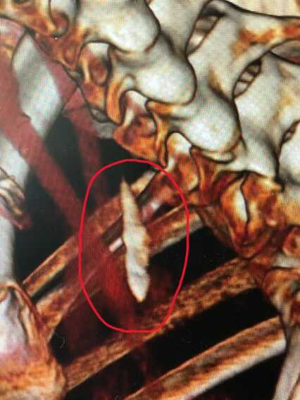 Galleria foto 'Ingoia un osso affilato che resta bloccato in gola: 54enne salvata al Policlinico' - foto 1