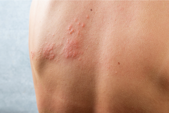 Galleria foto 'Dardani (Sir): “Herpes Zoster più rischioso per pazienti reumatologici”' - foto 1