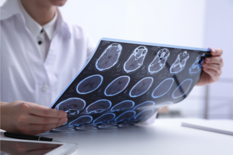 Sclerosi multipla, diagnosi precoce per ridurre il rischio di disabilità: lo studio dell’UniBa