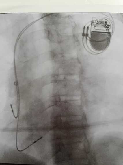 Galleria foto 'Barletta, al “Dimiccoli” il primo impianto di pacemaker bicamerale con una tecnica innovativa' - foto 2