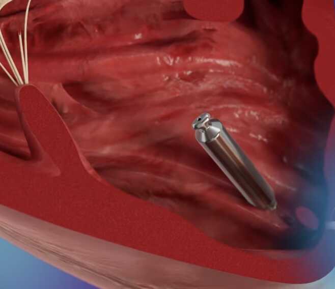 Andria, al Bonomo impiantato il primo pacemaker senza fili: dura più di 17 anni