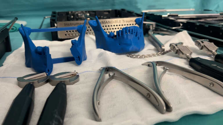 Policlinico di Bari, ricostruzioni ossee in 3D per ridurre i tempi degli interventi di chirurgia maxillo-facciale – VIDEO
