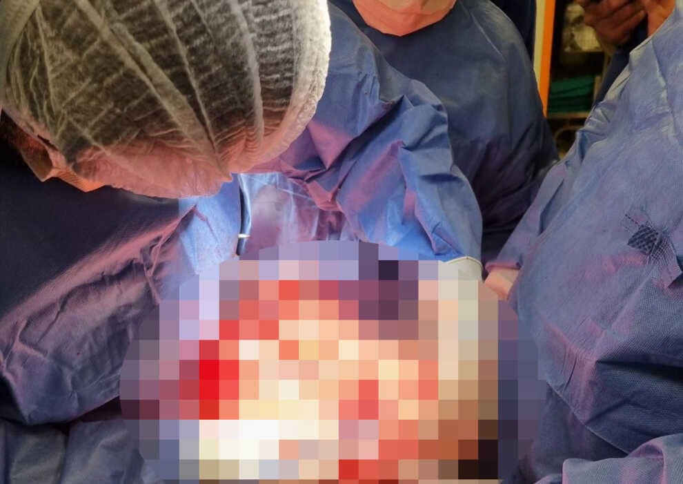 Matera, al Madonna delle Grazie asportato un tumore di 18 kg a una paziente 59enne