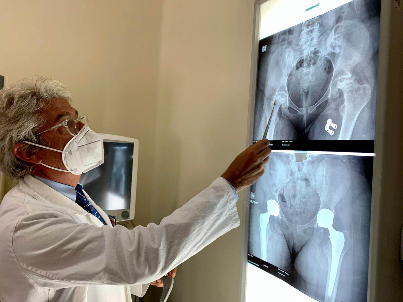 Bari, il Policlinico primo in Puglia per interventi di protesi di anca e ginocchio: 420 operazioni in un anno Bari, il Policlinico primo in Puglia per interventi di protesi di anca e ginocchio: 420 operazioni in un anno