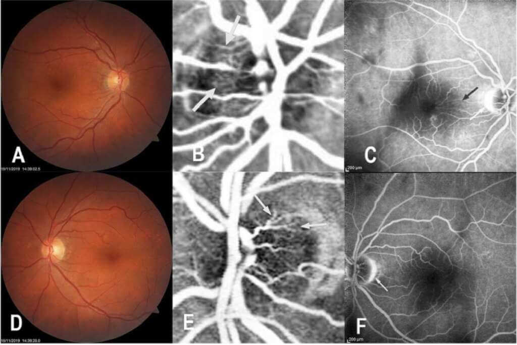 Galleria foto 'Altamura, all’ospedale della Murgia individuati causa e sviluppi di una malattia rara della retina' - foto 1