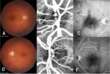 Altamura, all’ospedale della Murgia individuati causa e sviluppi di una malattia rara della retina