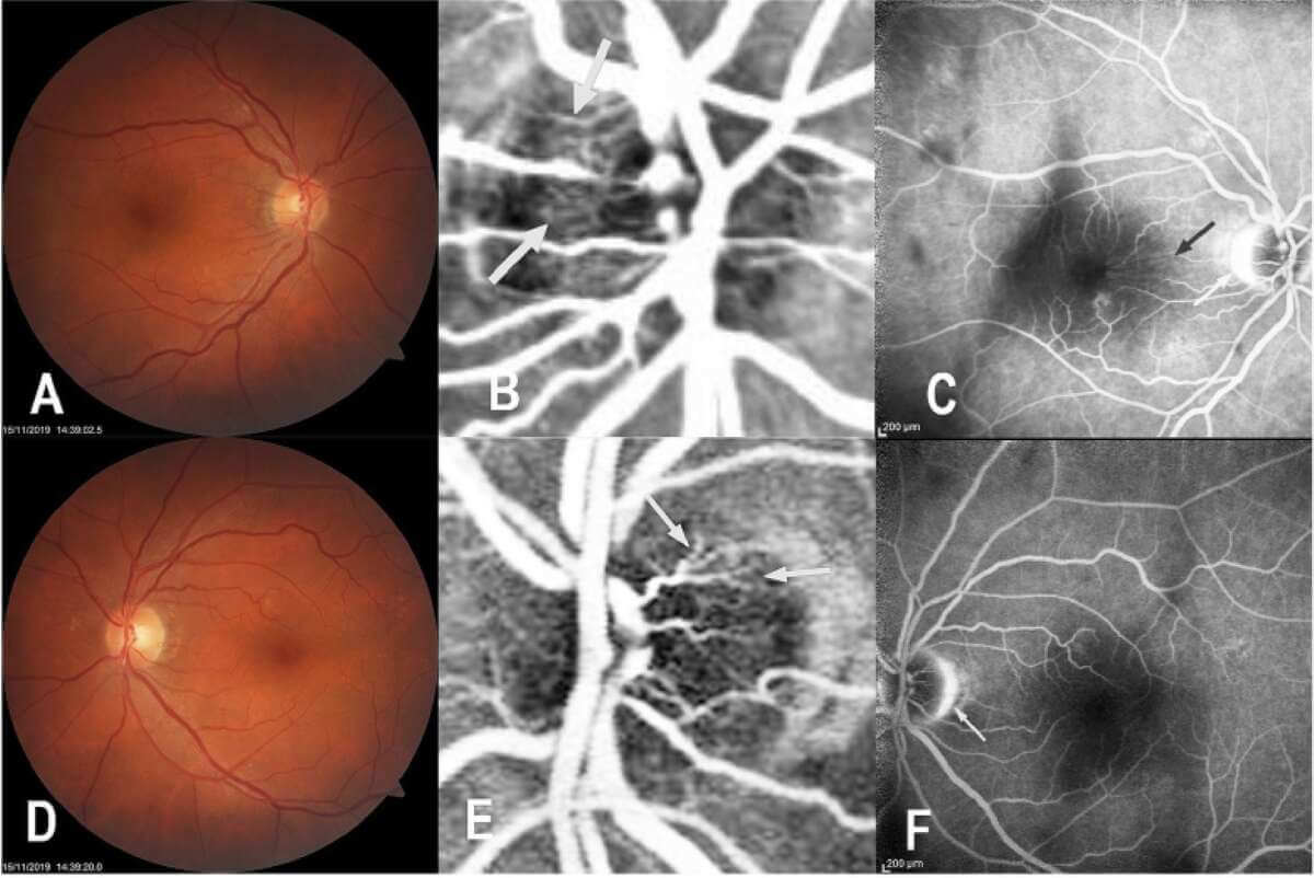 Altamura, all’ospedale della Murgia individuati causa e sviluppi di una malattia rara della retina