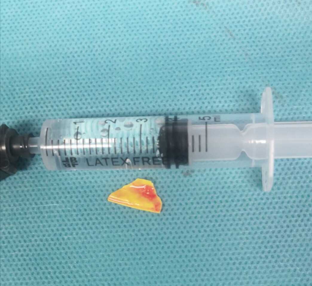 Bari, bimba di 14 mesi ingoia una scheggia di plastica: salvata con un intervento d’urgenza al Policlinico