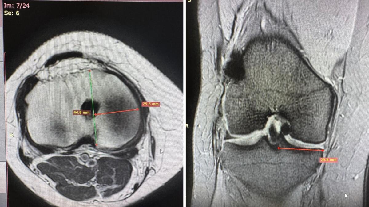 Galleria foto 'Bari, al Policlinico eseguito un trapianto di menisco da donatore: è la prima volta nel Sud Italia' - foto 1