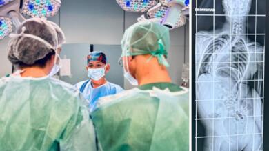 Bari, 15enne napoletano affetto da grave scoliosi operato con successo al Policlinico