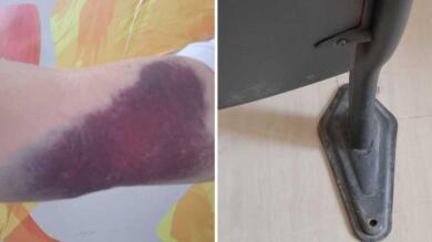 Foggia, paziente cade e rinuncia alla visita dopo «10 ore di attesa». Il Policlinico replica: «Assistenza tempestiva»