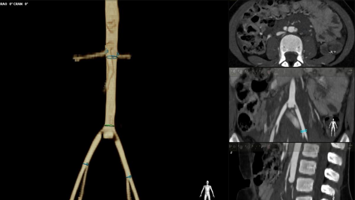 Bimba di 6 anni schiacciata da un’acquasantiera, operata d’urgenza a Bari: è in prognosi riservata